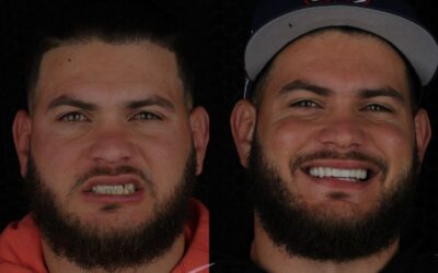 Diseño de Sonrisa en Bogotá: Guía Completa de Materiales, Precios y Resultados