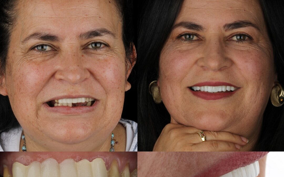 implantes-dental experience bogota