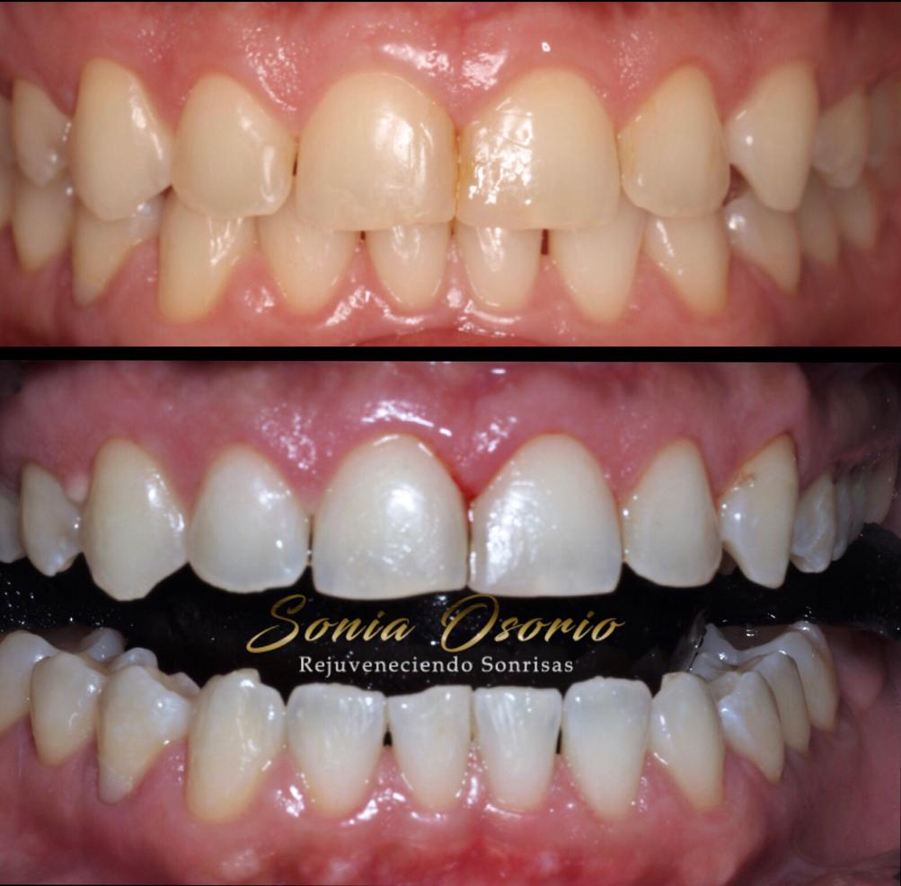 los mejores blanqueamientos de bogota