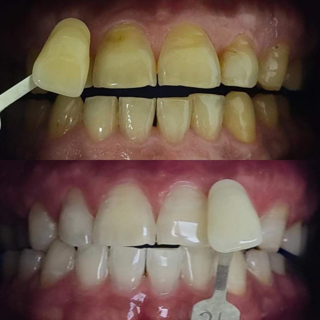 blanqueamiento dental experience