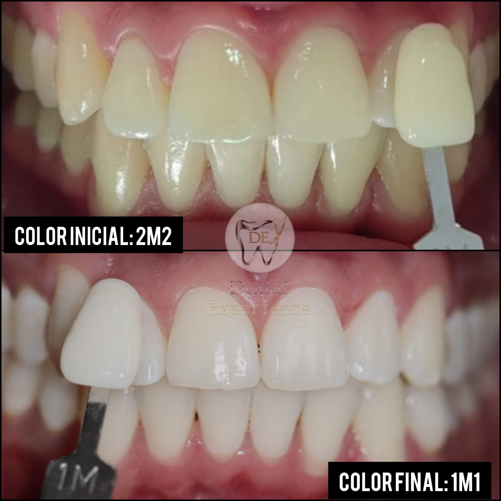 los mejores blanqueamientos de bogota